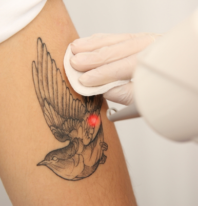 Tattoo Removal Image