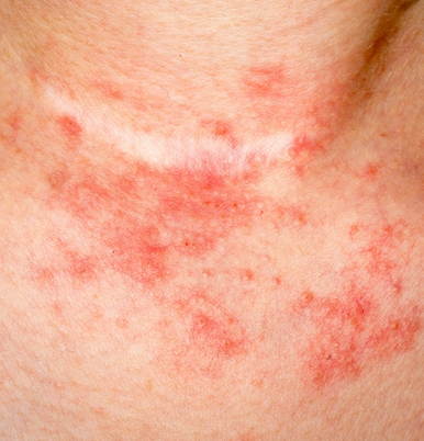 Eczema Relief Image